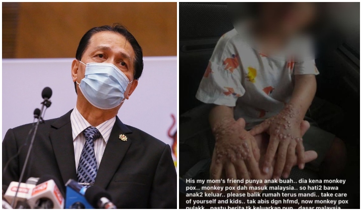 Viral Monkeypox di Malaysia tidak benar
